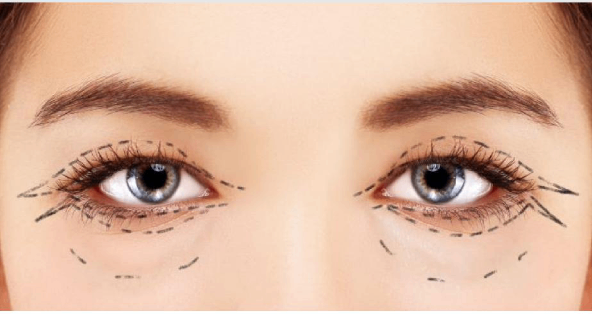 Blefaroplastia